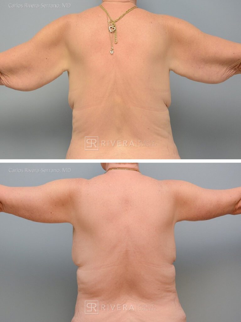 Arm lift in woman -Brachioplasty - before and after case 1 - posterior view