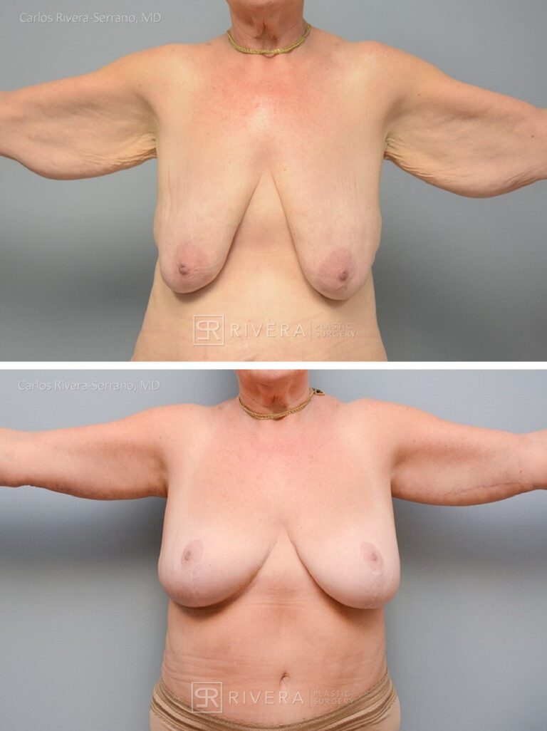 Arm lift in woman - Brachioplasty - before and after case 1 - frontal view