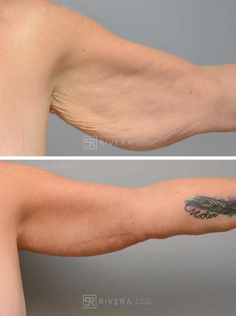 Arm lift in woman - Brachioplasty - before and after case 1 - frontal view