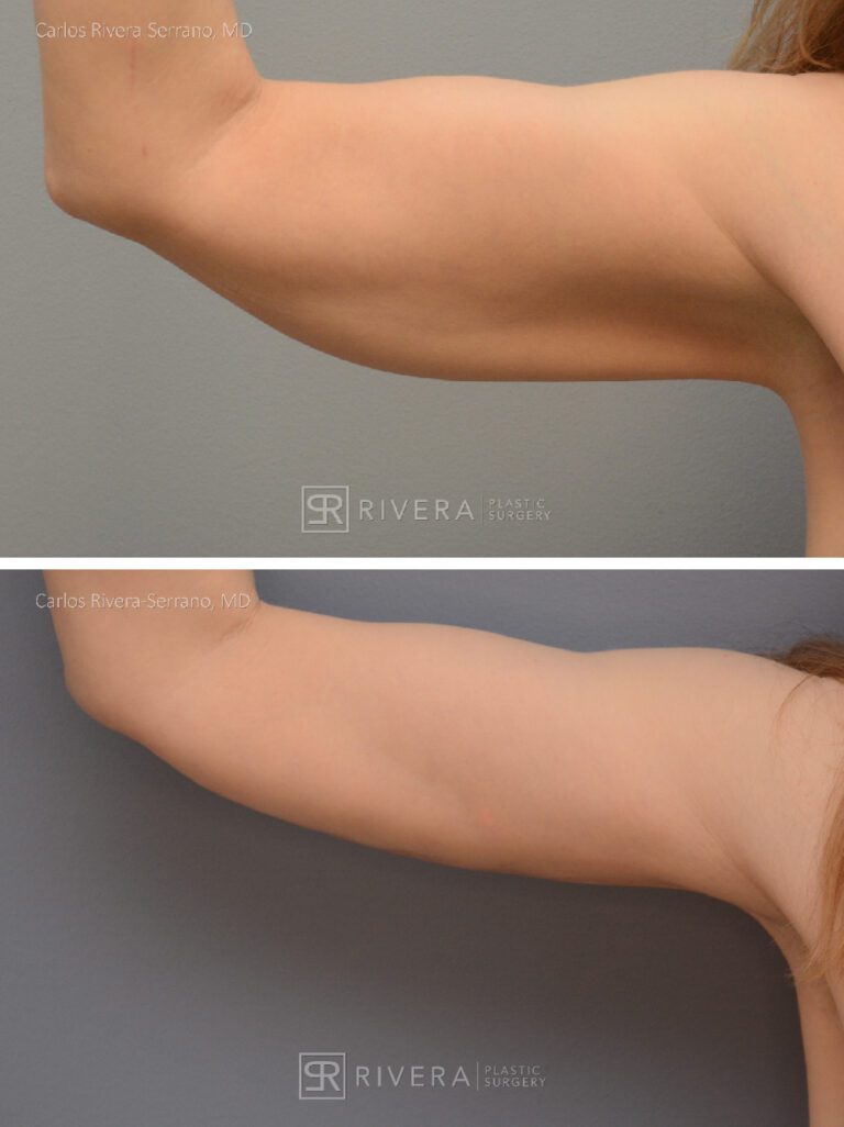 Arm lift in woman - Brachioplasty - before and after case 2 - frontal view