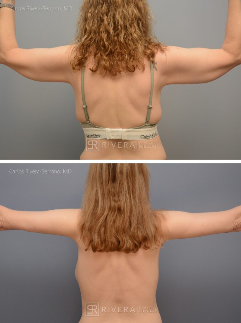 Arm lift in woman - Brachioplasty - before and after case 2 - posterior view