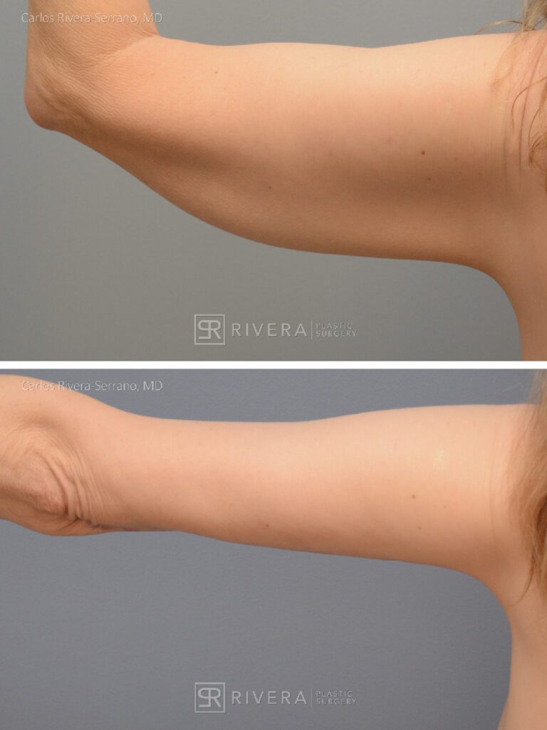 Arm lift in woman - Brachioplasty - before and after case 2 - posterior view