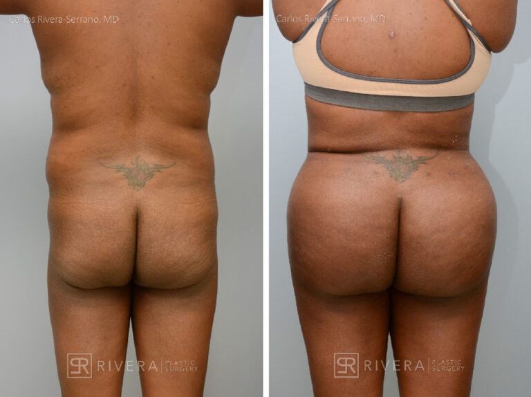 Brazilian butt lift (with fat transfer) tailored to the patient's etnic request. - Woman - Case 3201 - Before and after - Posterior view