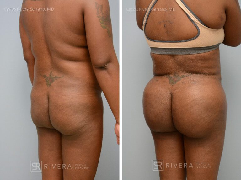 Brazilian butt lift (with fat transfer) tailored to the patient's etnic request. - Woman - Case 3201 - Before and after - Oblique view