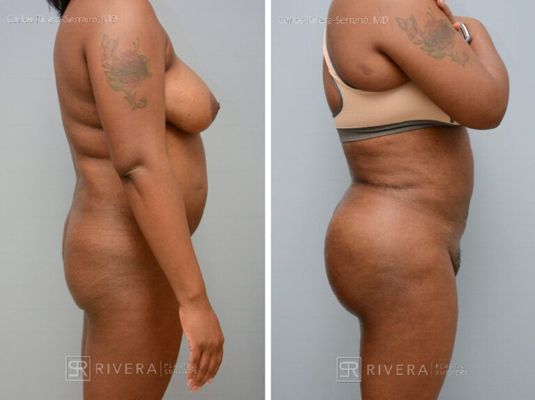 Brazilian butt lift (with fat transfer) tailored to the patient's etnic request. - Woman - Case 3201 - Before and after - Lateral view