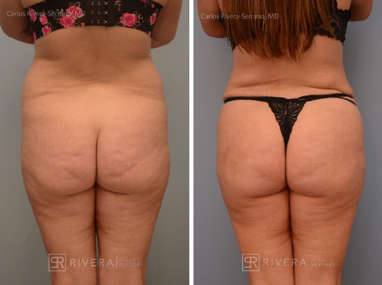 Brazilian butt lift (augmentation with fat transfer) with concomitant abdominoplasty, tailored to the patients request. The BBL when done wih concomitant abdominoplasty needs to be more conservative (1 L max) due to technical and state regulations - Woman - Case 3202 - Before and after - Posterior view
