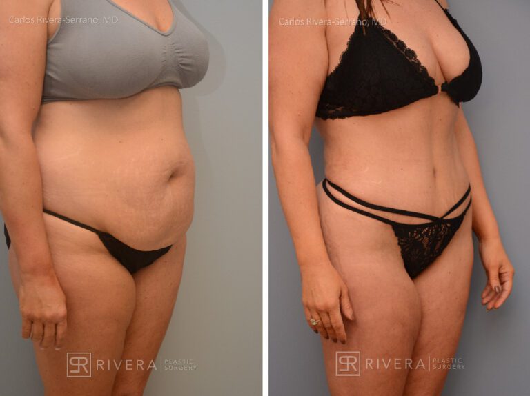 Brazilian butt lift (augmentation with fat transfer) with concomitant abdominoplasty, tailored to the patients request. The BBL when done wih concomitant abdominoplasty needs to be more conservative (1 L max) due to technical and state regulations - Woman - Case 3202 - Before and after - Oblique view