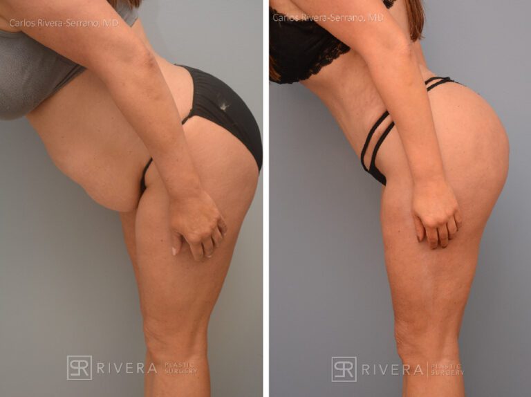 Brazilian butt lift (augmentation with fat transfer) with concomitant abdominoplasty, tailored to the patients request. The BBL when done wih concomitant abdominoplasty needs to be more conservative (1 L max) due to technical and state regulations - Woman - Case 3202 - Before and after - Lateral view