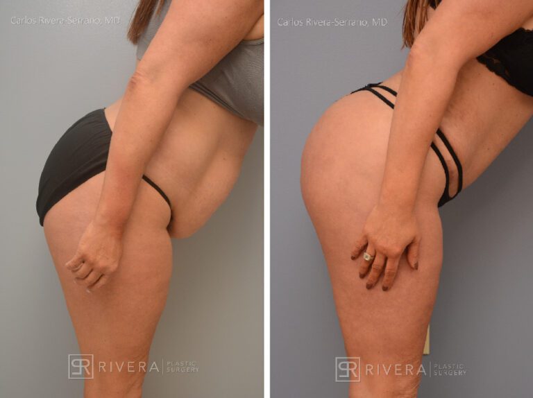 Brazilian butt lift (augmentation with fat transfer) with concomitant abdominoplasty, tailored to the patients request. The BBL when done wih concomitant abdominoplasty needs to be more conservative (1 L max) due to technical and state regulations - Woman - Case 3202 - Before and after - Lateral view