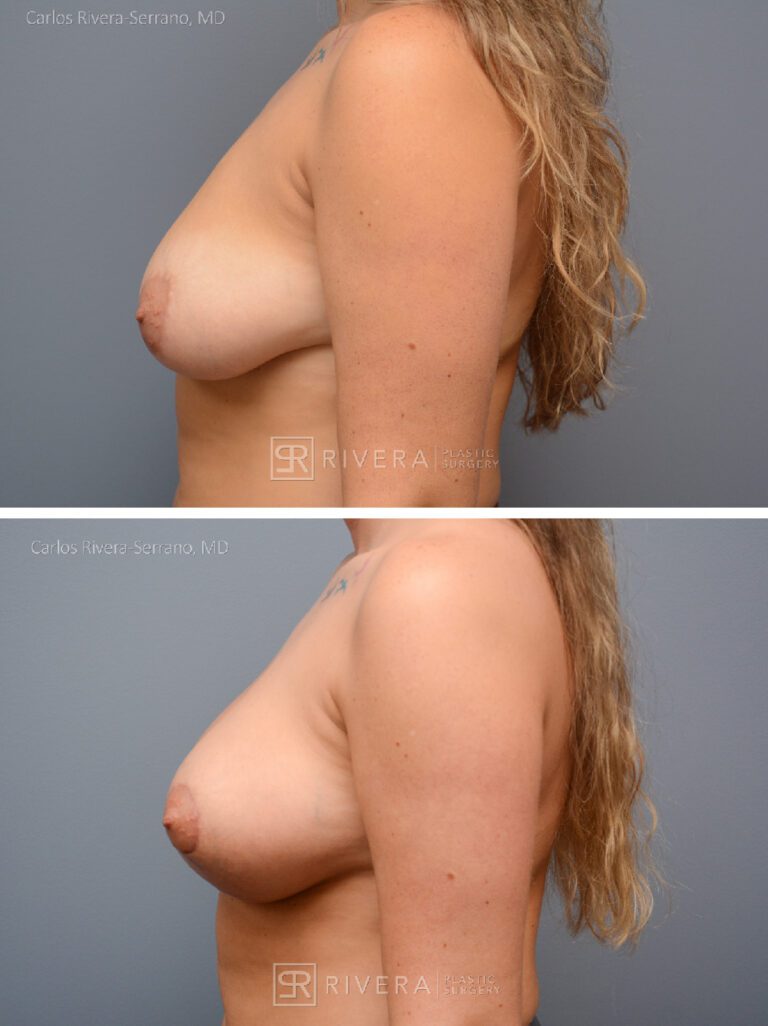 Breast lift with implants. Single stage (One single surgery). 330 cc silicone filled smooth implant dual plane - Woman - Case 2501 - Before and after - Lateral view