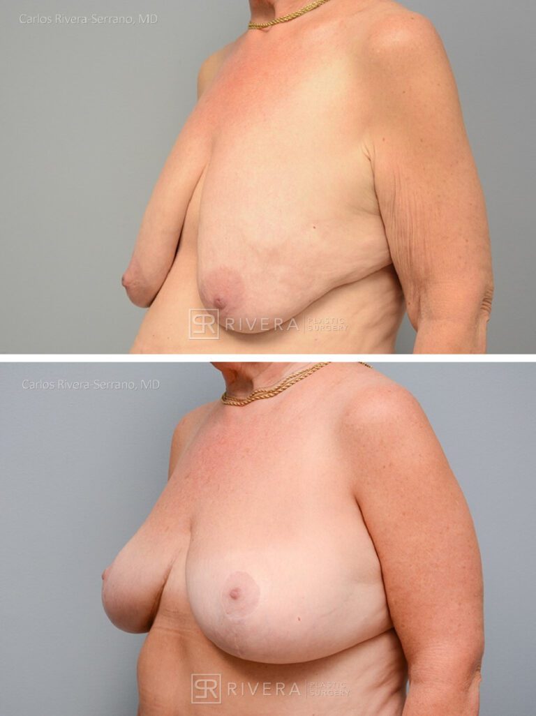 Breast lift surgery woman - Breast lift - Breast - Before and after case 1 - Lateral view