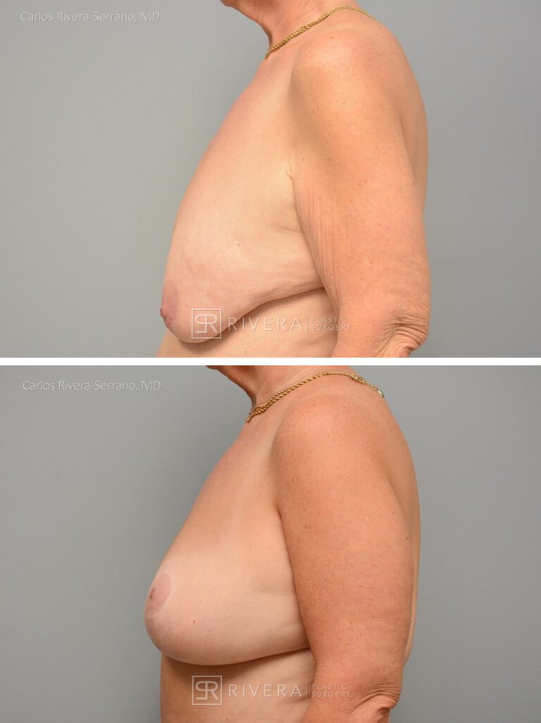Breast lift surgery woman - Breast lift - Breast - Before and after case 1 - Profile view