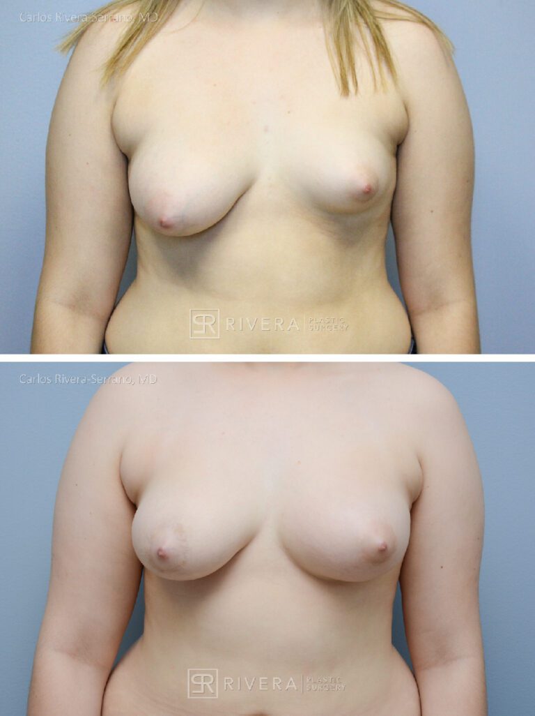 Breast lift surgery woman - Breast lift - Breast - Before and after case 3 - Frontal view