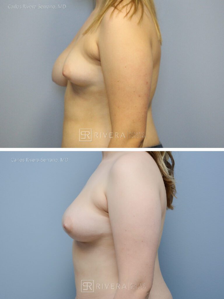 Breast lift surgery woman - Breast lift - Breast - Before and after case 3 - Profile view