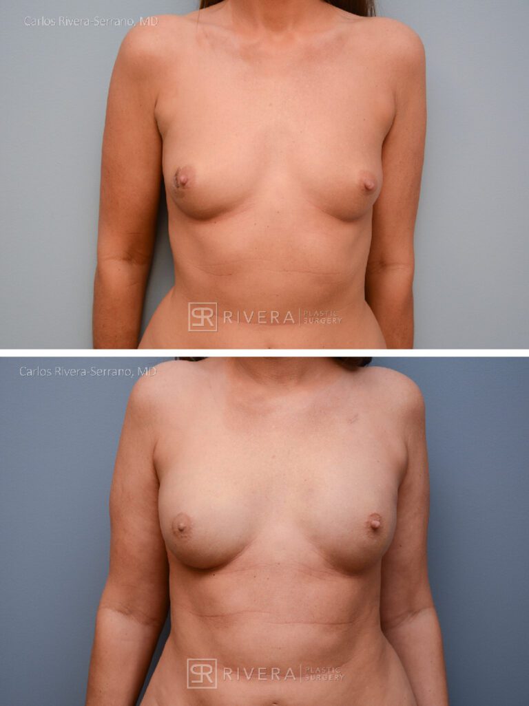 breastreconstruction case2 dr carlos rivera serrano