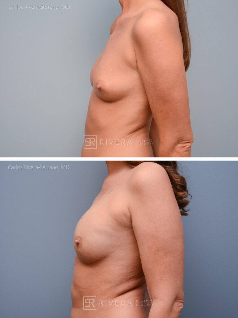 Nipple sparing mastectomy (bilateral) & reconstruction with implants - Woman - Case 26102 - Before and after - Lateral view