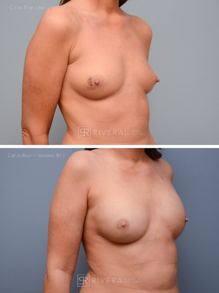 Nipple sparing mastectomy (bilateral) & reconstruction with implants - Woman - Case 26102 - Before and after - Oblique view