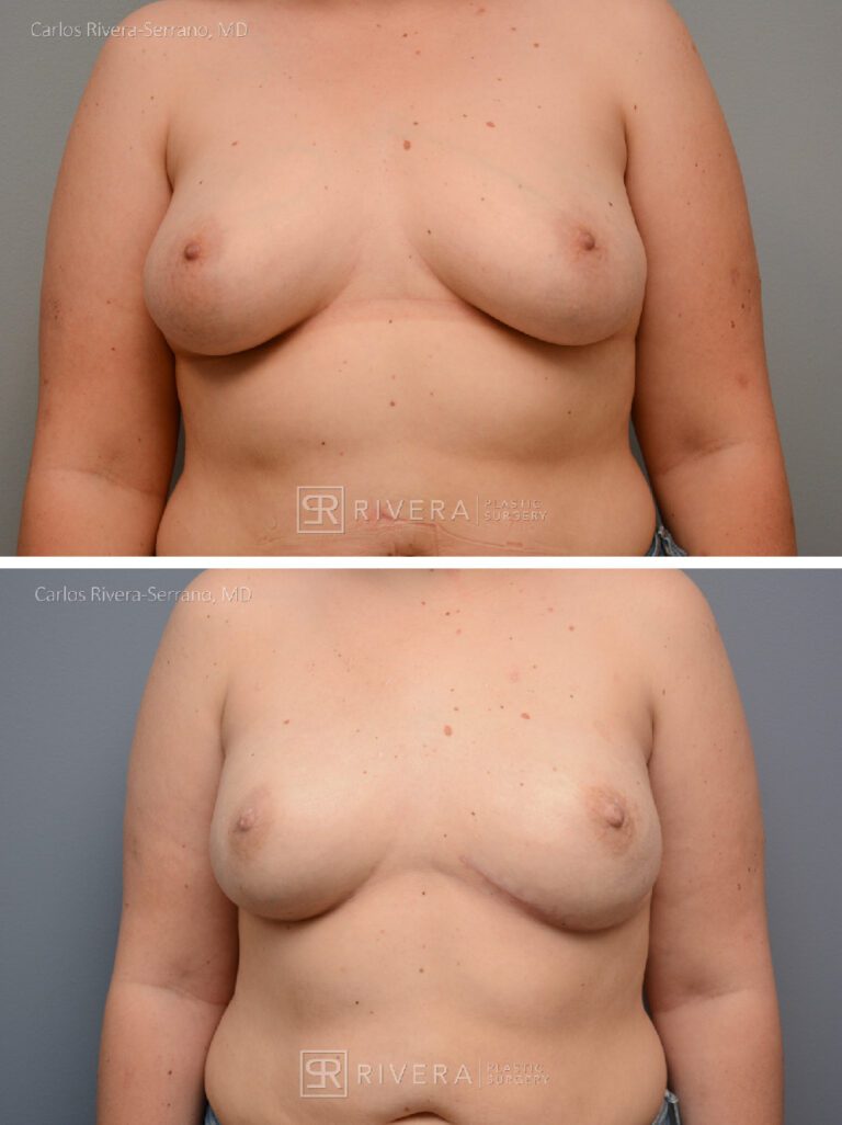 Nipple sparing mastectomy (bilateral) & reconstruction with implants - Woman - Case 26103 - Before and after - Frontal view