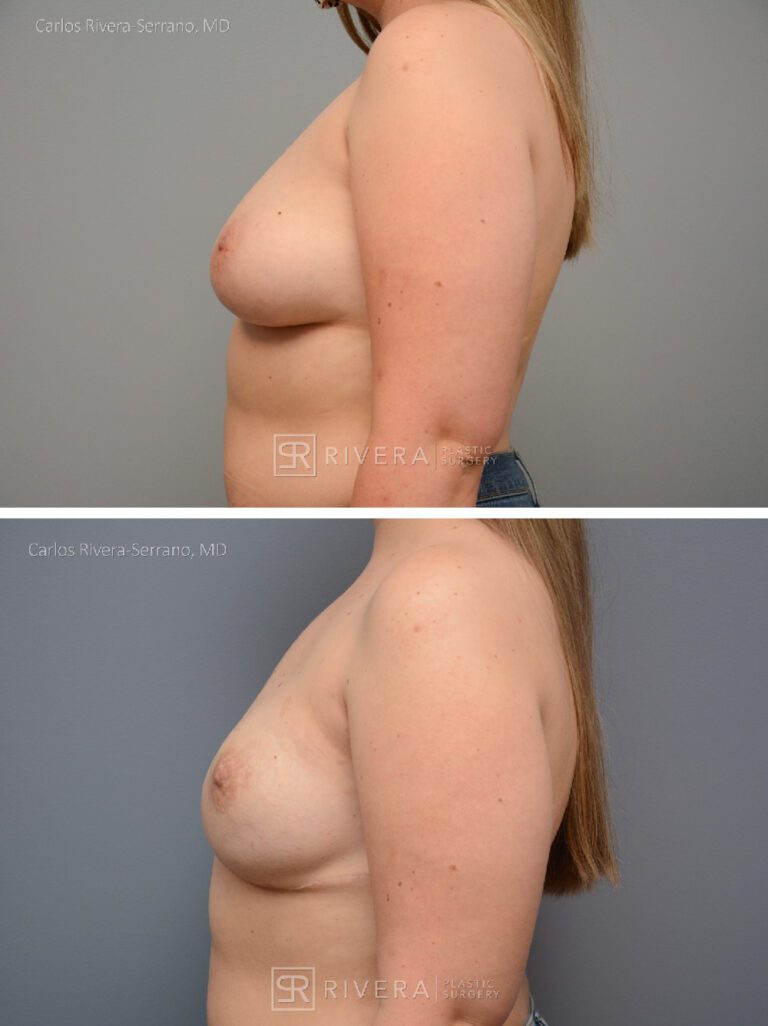 Nipple sparing mastectomy (bilateral) & reconstruction with implants - Woman - Case 26103 - Before and after - Lateral view