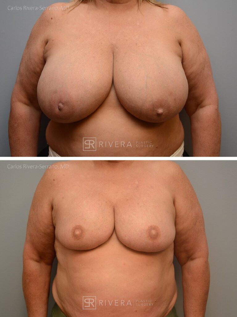 Mastectomy (bilateral) & reconstruction with implants nipple reconstruction and areola tattoos - Woman - Case 26104 - Before and after - Frontal view