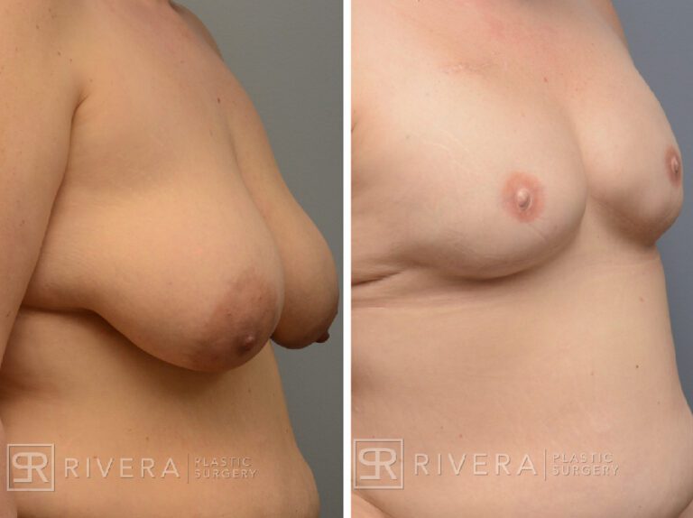 Mastectomy (bilateral) & reconstruction with implants nipple reconstruction and areola tattoos - Woman - Case 26105 - Before and after - Oblique view