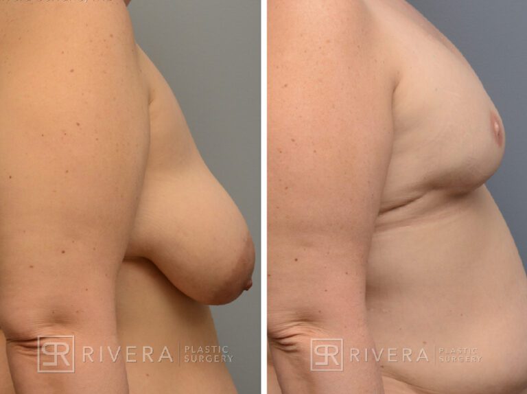 breastreconstruction case5.2 dr carlos rivera serrano