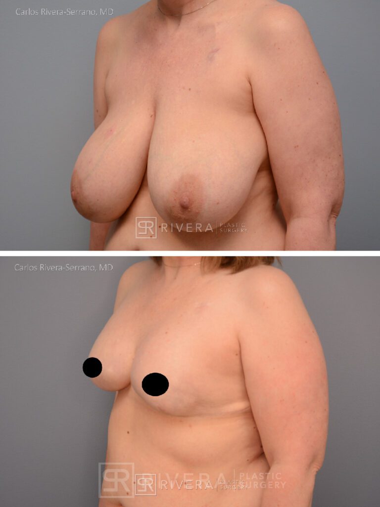 Mastectomy (bilateral) & reconstruction with implants - Woman - Case 26106 - Before and after - Oblique view