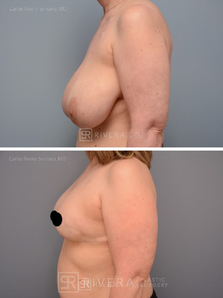 Mastectomy (bilateral) & reconstruction with implants - Woman - Case 26106 - Before and after - Lateral view