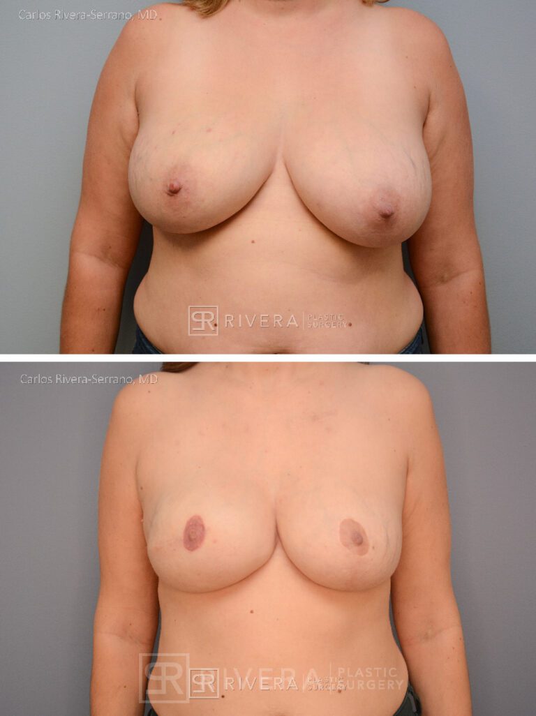 Right Mastectomy & reconstruction with implant nipple reconstruction and areola tattoos - Woman - Case 26107 - Before and after - Frontal view