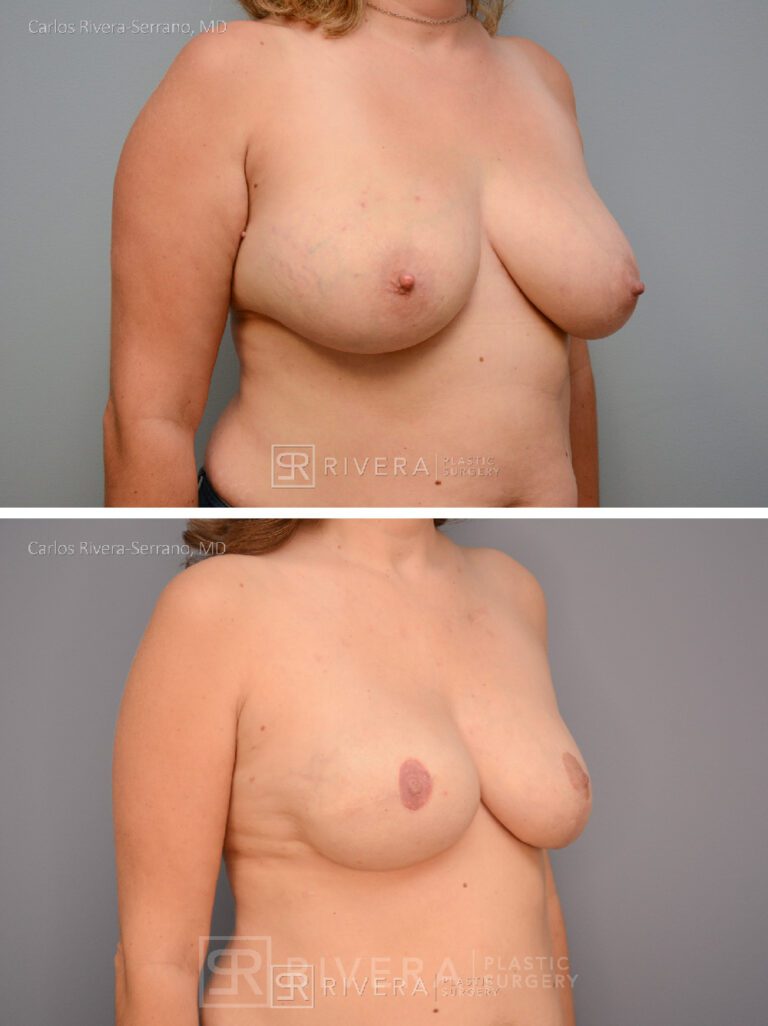 Right Mastectomy & reconstruction with implant nipple reconstruction and areola tattoos - Woman - Case 26107 - Before and after - Oblique view