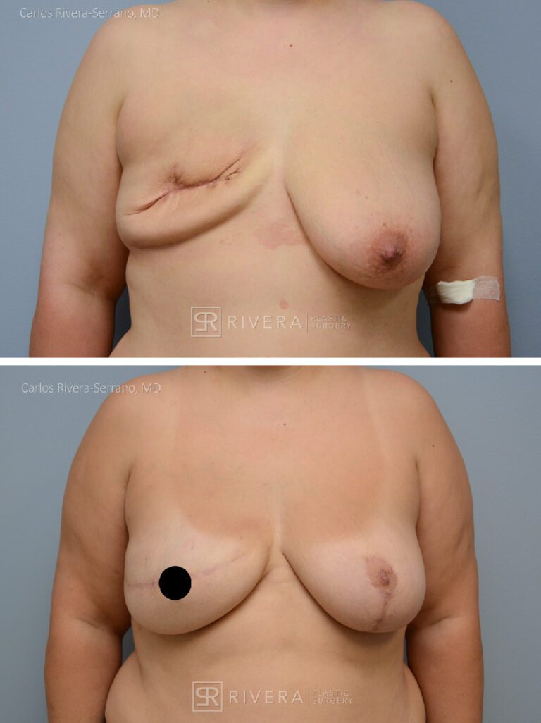 Right Mastectomy & reconstruction with implant - Woman - Case 26108 - Before and after - Frontal view
