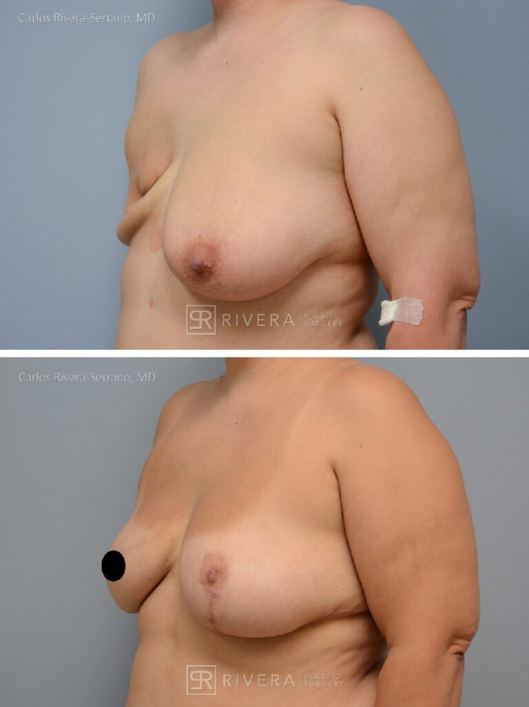 Right Mastectomy & reconstruction with implant - Woman - Case 26108 - Before and after - Oblique view