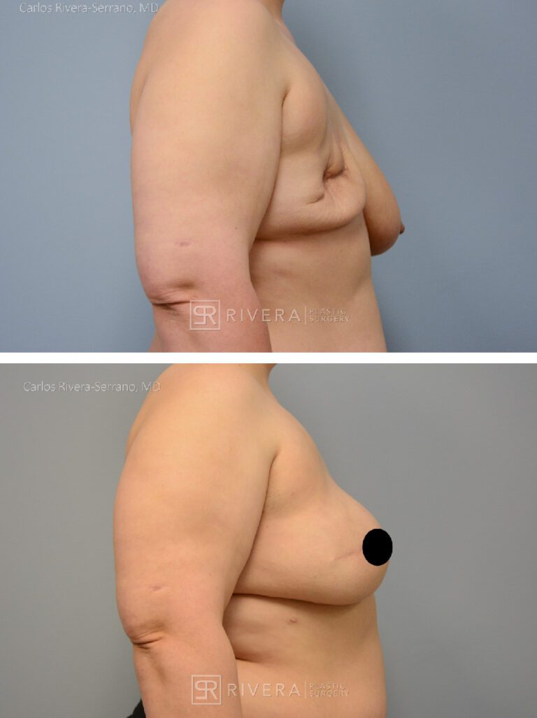 Right Mastectomy & reconstruction with implant - Woman - Case 26108 - Before and after - Lateral view