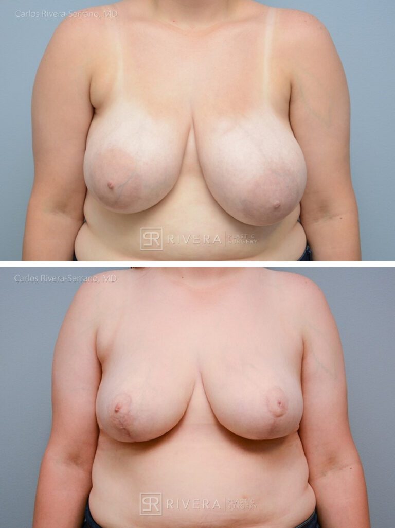 Bilateral breast reduction superomedial dermoglandular pedicle, Wise skin pattern approach (inverted T) - Woman - Case 23015 - Before and after - Frontal view