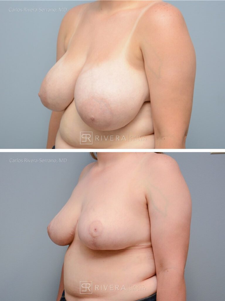Bilateral breast reduction superomedial dermoglandular pedicle, Wise skin pattern approach (inverted T) - Woman - Case 23015 - Before and after - Oblique view