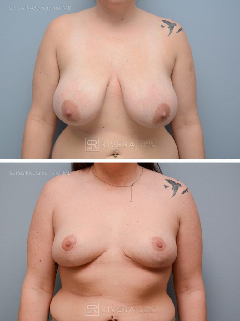 breastreduction case16 dr carlos rivera serrano