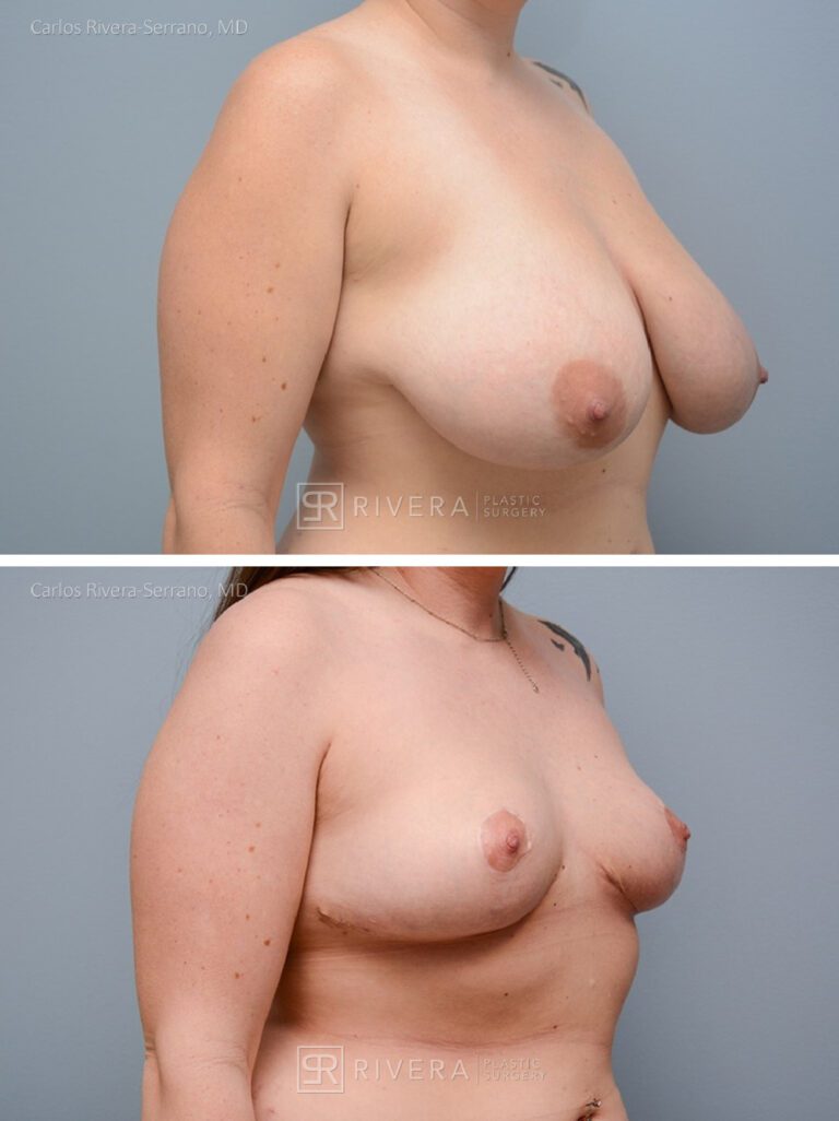 breastreduction case16.1 dr carlos rivera serrano