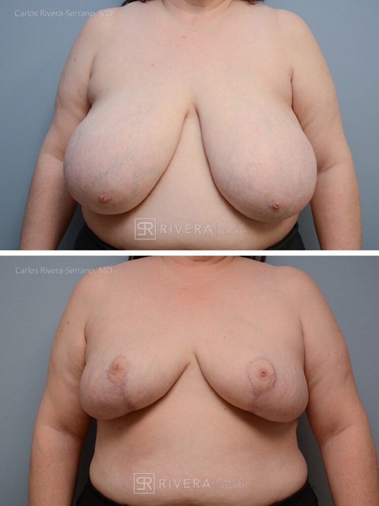 breastreduction case17 dr carlos rivera serrano