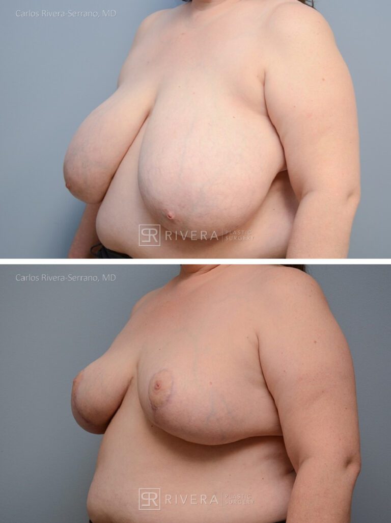 breastreduction case17.1 dr carlos rivera serrano