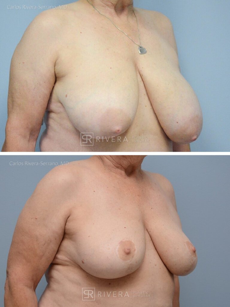 breastreduction case18.1 dr carlos rivera serrano