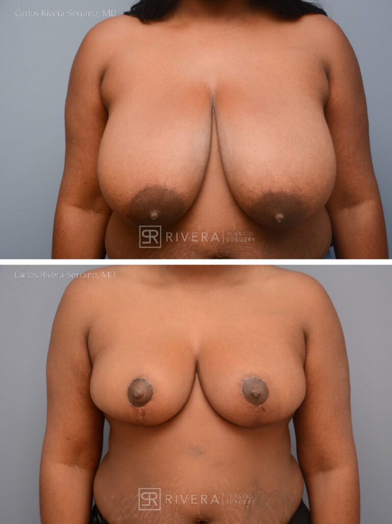 breastreduction case20 dr carlos rivera serrano