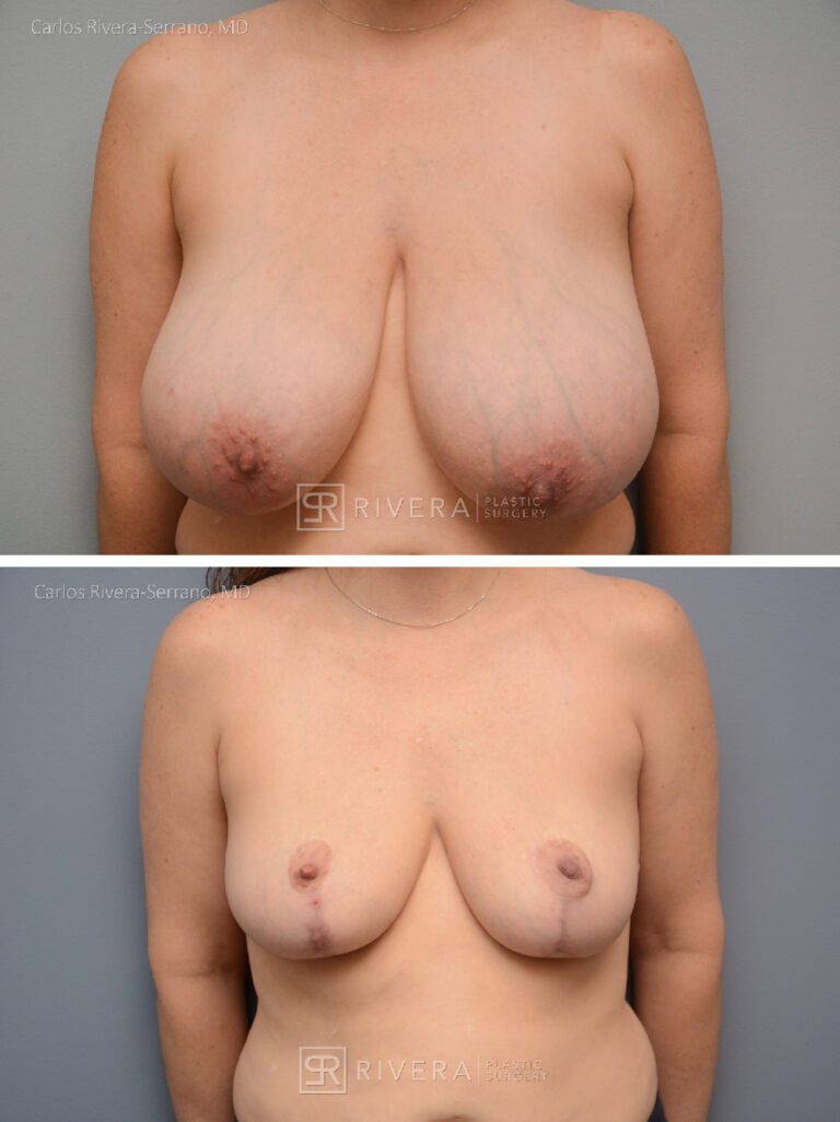 breastreduction case22 dr carlos rivera serrano