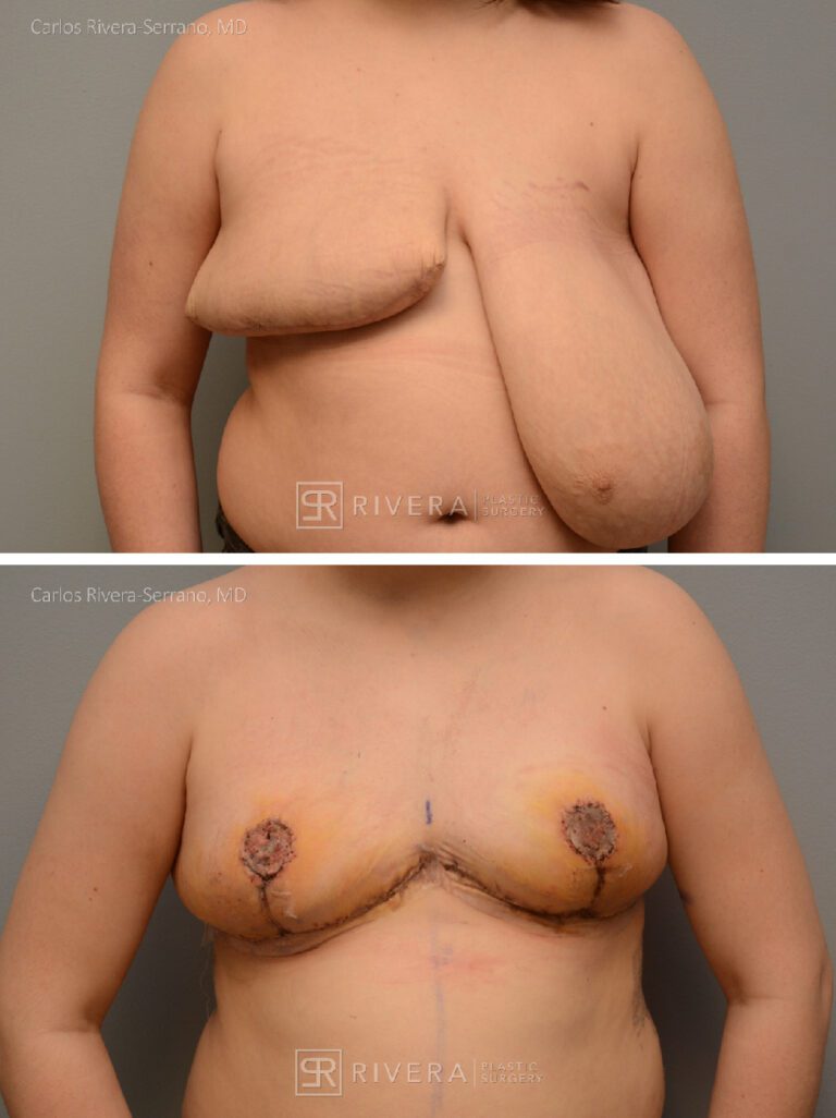 Bilateral breast reduction and reshaping. The right breast was partially removed by a another surgeon due to medical concerns. The post op photo shows an early result - Woman - Case 26203 - Before and after - Frontal view