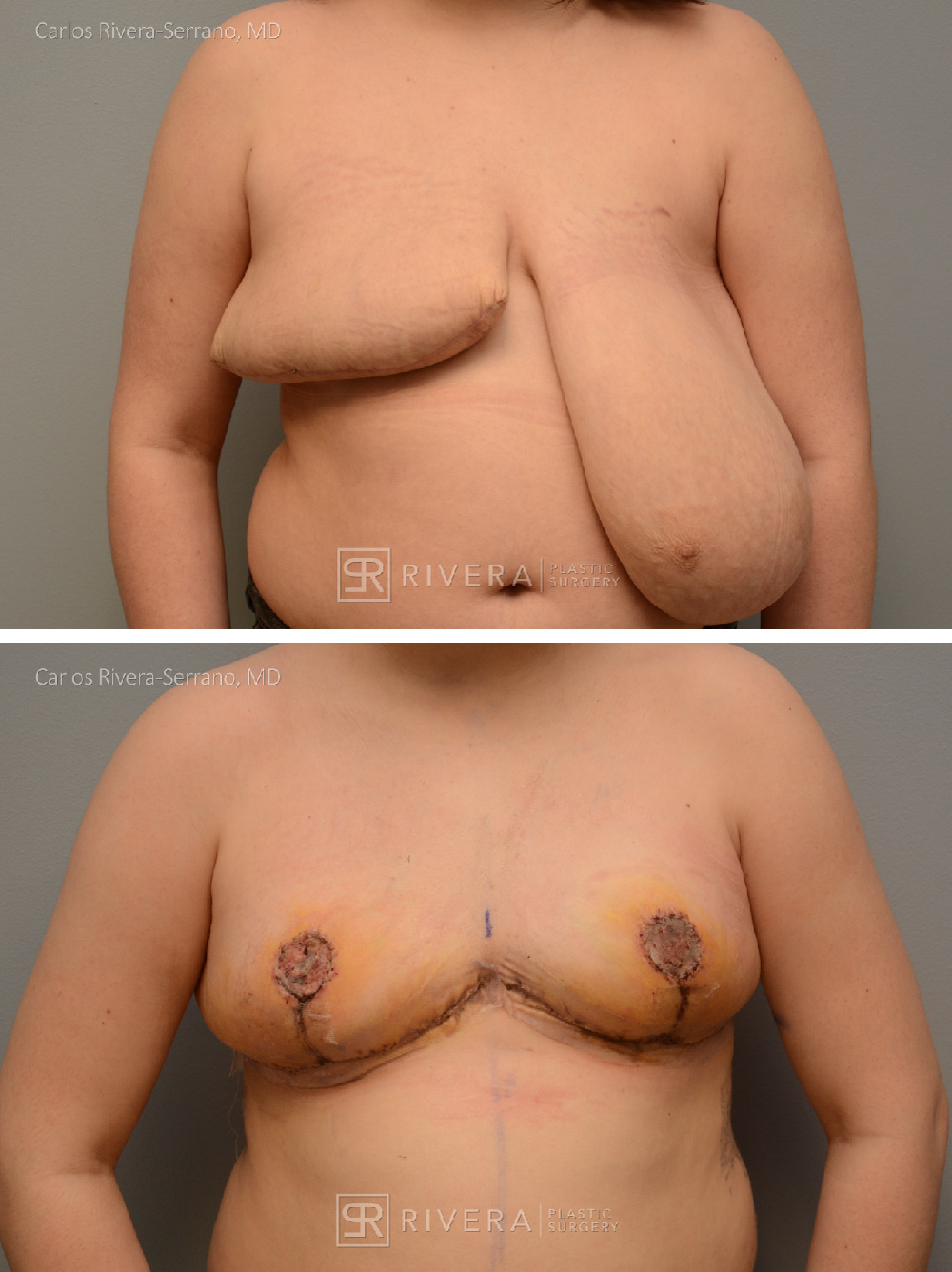 Breast Reduction Gallery - Case #23 - Dr. Carlos Rivera-Serrano MD