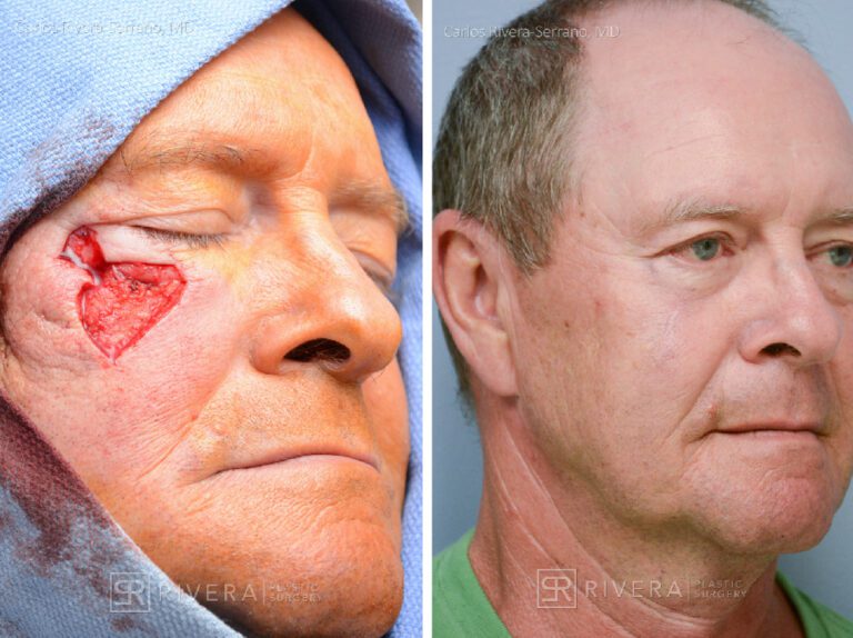 Cheek - lower eyelid wound reconstruction from skin cancer removal with Burow's Triangle Displacement Flap - Man - Case 111210 - Before and after - Oblique view