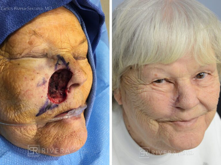Cheek & Nose wound reconstruction from skin cancer removal with cheek Advancement flaps - Woman - Case 111211 - Before and after - Oblique view