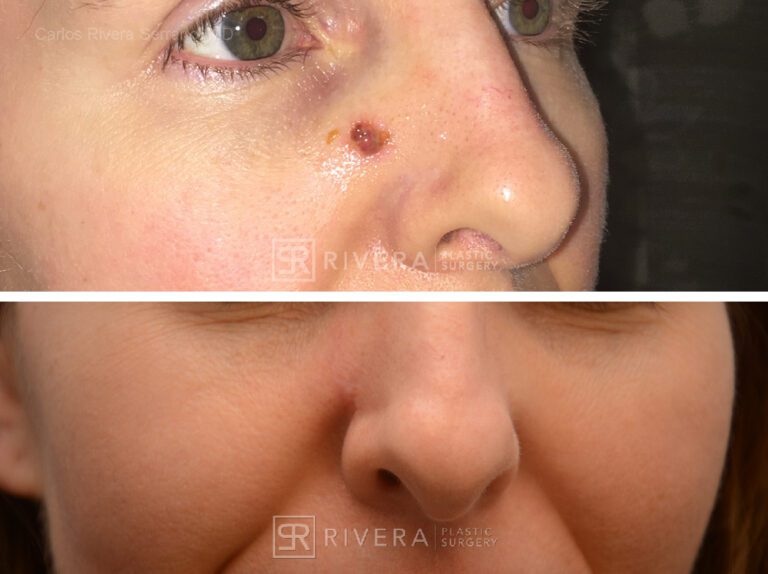 Cheek wound reconstruction from skin cancer removal with Burow's Triangle Displacement flaps - Woman - Case 111212 - Before and after - Lateral view