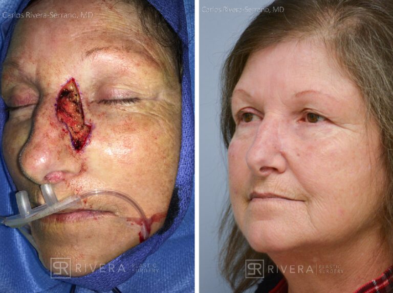 Cheek and nose wound reconstruction from skin cancer removal with Burow's Triangle Displacement flaps - Woman - Case 111213 - Before and after - Oblique view