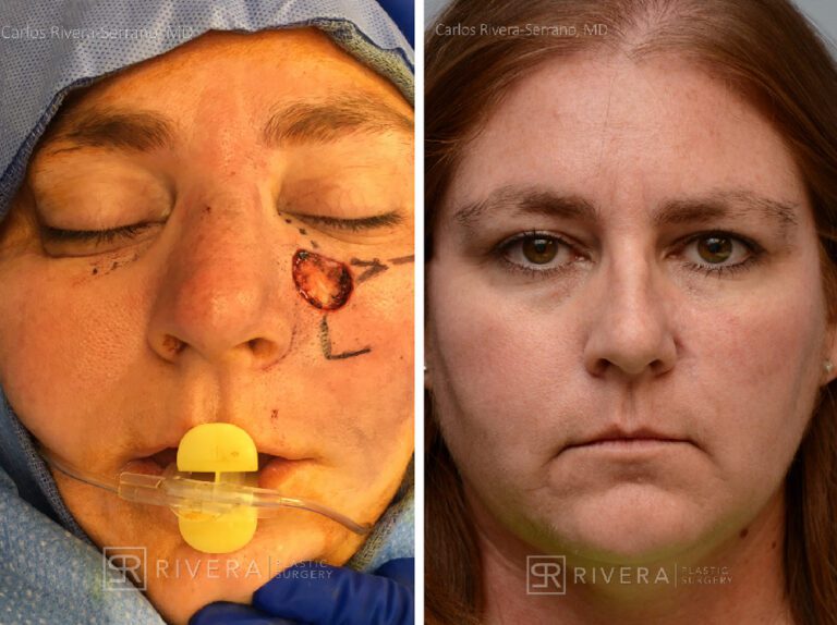 Cheek wound reconstruction from skin cancer removal with Burow's Triangle Displacement flaps - Woman - Case 111215 - Before and after - Frontal view