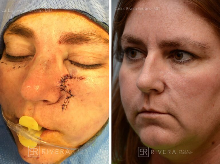 Cheek wound reconstruction from skin cancer removal with Burow's Triangle Displacement flaps - Woman - Case 111215 - Before and after - Oblique view